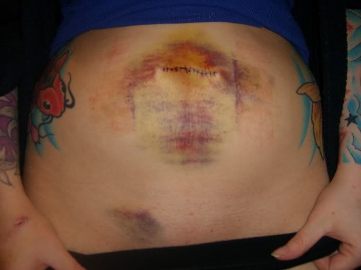 Modification Belly Button Removal is bellybutton removal possible awesome modifications Modification Belly Button Removal is bellybutton removal possible awesome modifications
