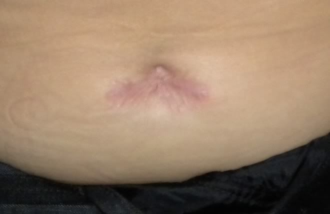 Navel Removal