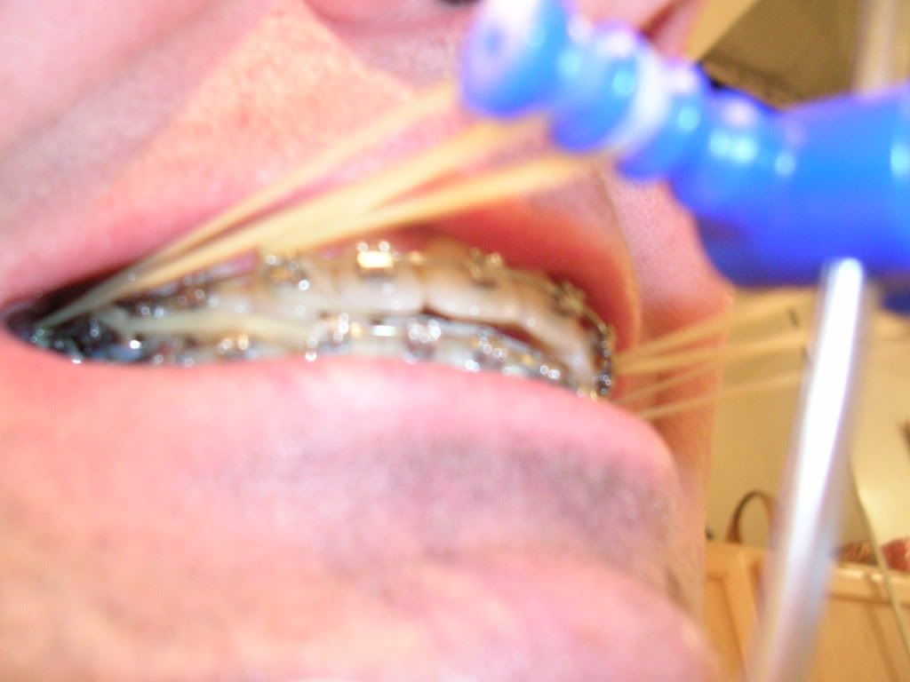 Close Up Headgear Braces Photo by notbobs Photobucket